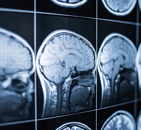 brain-injury